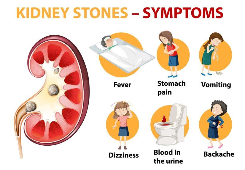 Kidney_Stones