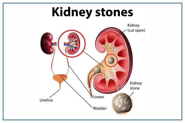 kidney-stones-overview