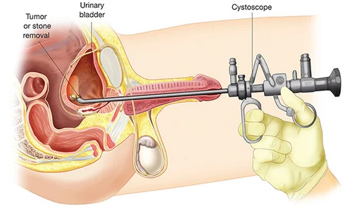 prostate-laser-surgery-500x500