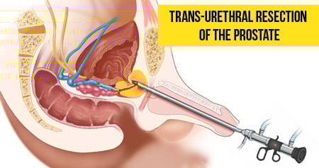 trans-urethral-resection-of-the-prostate